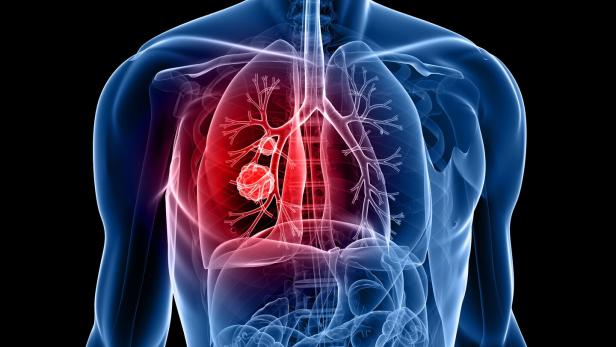 lung cancer