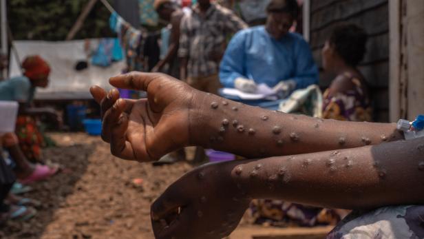 Mpox wütet in Ruanda besonders stark Mpox wütet in Ruanda besonders stark
