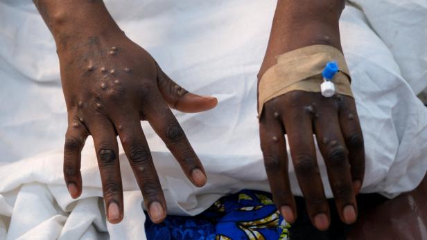 Die Hände eines Patienten mit durch das Mpox-Virus verursachten Hautausschlägen in Kinshasa.