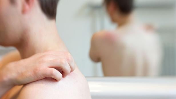 Mehr als Bläschen: Gürtelrose kann Nervenschmerzen verursachen