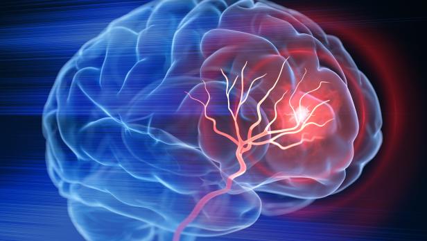 Brain stroke