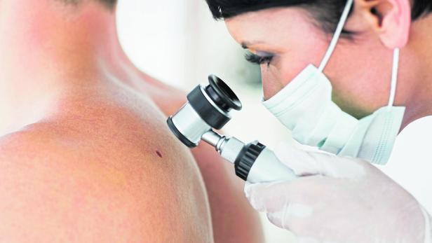 Dermatologist examining mole on patient Dermatologist examining mole on patient