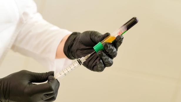 Plättchenreiches Plasma zur Injektion gegen Rückenschmerzen