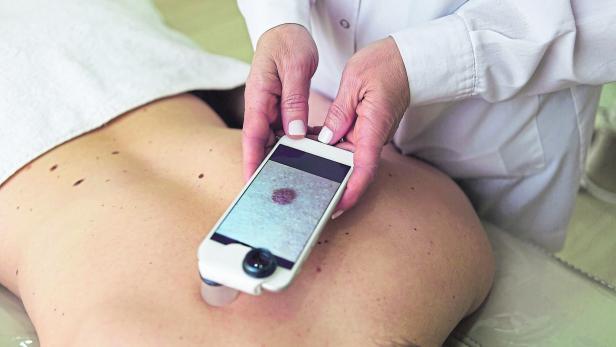 Female doctor examining moles of a patient with magnifying glass on smartphone