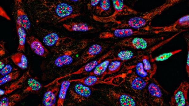 Fluorescent Imaging immunofluorescence of cancer cells growing in 2D with nuclei in blue, cytoplasm in red and DNA damage foci in green Fluorescent Imaging immunofluorescence of cancer cells growing in 2D with nuclei in blue, cytoplasm in red and DNA damage foci in green