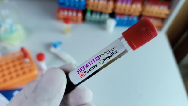 Hepatitis-Virus-Test in Händen eines Labotmitarbeiters.