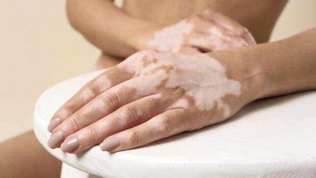Am Mittwoch 25.6. ist Welt-Vitiligo-Tag: Warum die Weißfleckenkrankheit ernst genommen werden muss