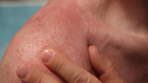 Gerötete Haut mit Blasen auf männlicher Schulter und Rücken.