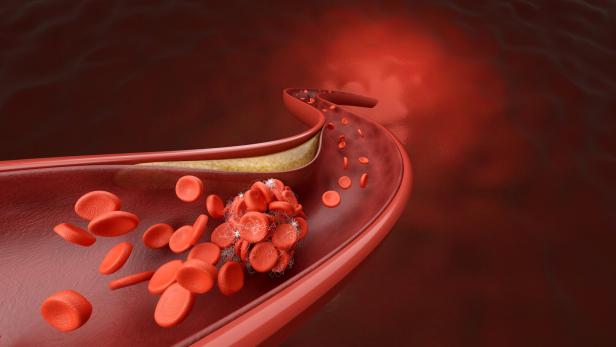 coronary artery and blood clot coronary artery and blood clot