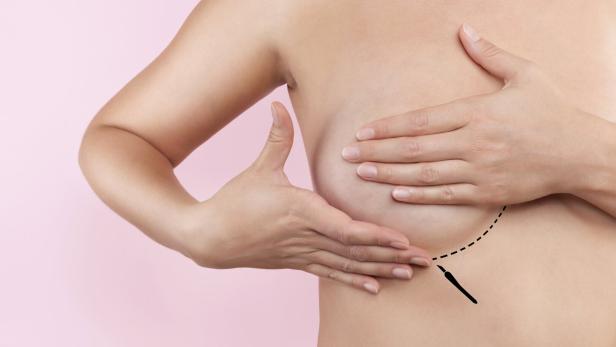 breast augmentation