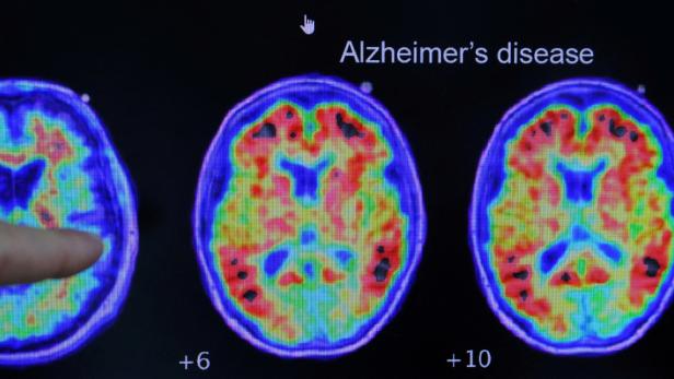 FILE PHOTO: Evidence of Alzheimers disease on PET scans at the Center for Alzheimer Research and Treatment in Boston