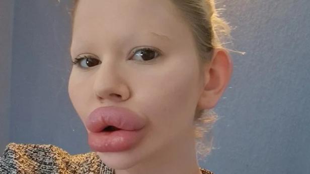 Eine Bulgarin (27) hat die größten Lippen der Welt.