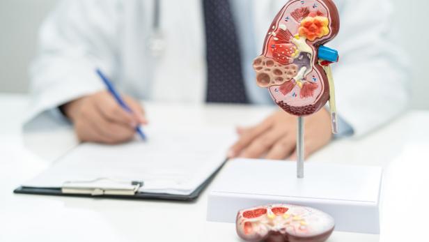 Kidney disease, Chronic kidney disease ckd, Doctor with human model to study and treat in hospital.