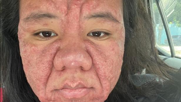 Frau mit extremen Hautveränderungen, die auf ihre Schwangerschaft zurückzuführen sind.