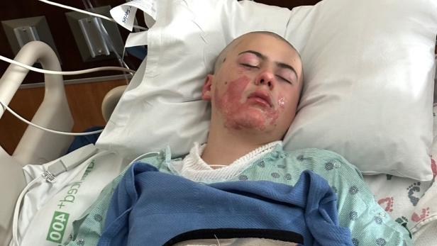 12-Jähriger liegt mit Verbrennungen im Krankenbett