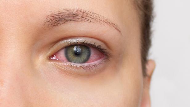 Close Up von einer Frau mit einem roten Auge