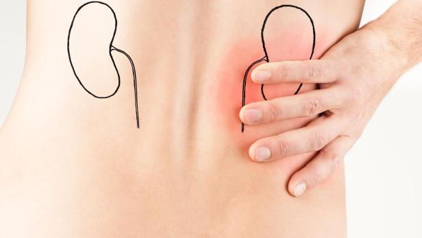 Abbildung eines Mannes mit Rückenschmerzen und einer kleinen Niere auf seinem Rücken, die Nierenschmerzen verdeutlicht.