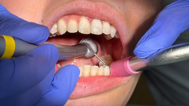 Ein Zahnbohrer, der im Mund eines Patienten verwendet wird.