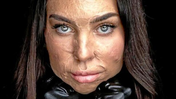 Mafalda Da Silva Baptista lebt mittlerweile schmerzfrei – ihre Narben bleiben für immer. 