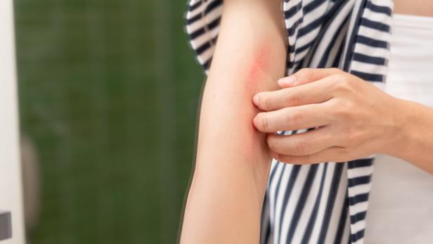 skin problem and beauty. Young woman scratch body has itchy skin from skin allergic, steroid allergy, sensitive skin, red from sunburn, chemical allergy, rash, insect bites, Seborrheic Dermatitis.