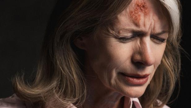 Frau mit schmerzverzerrtem Gesicht und Gürtelrose-Ausschlag auf der Stirn.
