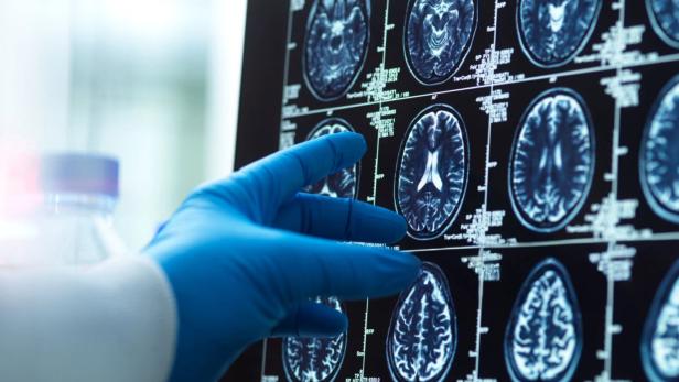 Brain scan image with a doctor's hand, representing medical diagnosis and research.