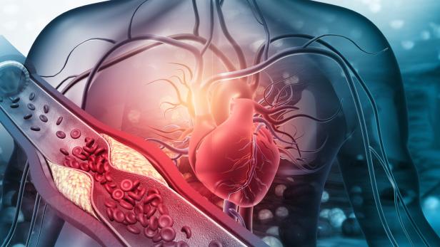 Die Illustration zeigt eine Darstellung des menschlichen Herzens, davor als Symbol ein vergrößertes Blutgefäß, das bereits durch Cholesterinablagerungen verengt ist. 