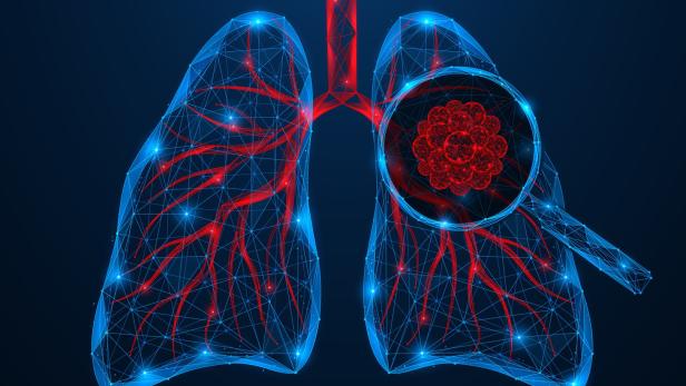 Human lung cancer under a magnifying glass.