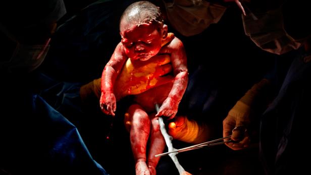 Ein neugeborenes Baby wird von Ärzten nach einer Operation gehalten.