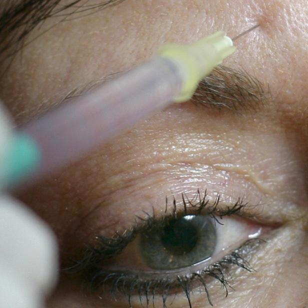 Eine Frau erhält eine Injektion in die Stirn zur Faltenbehandlung.