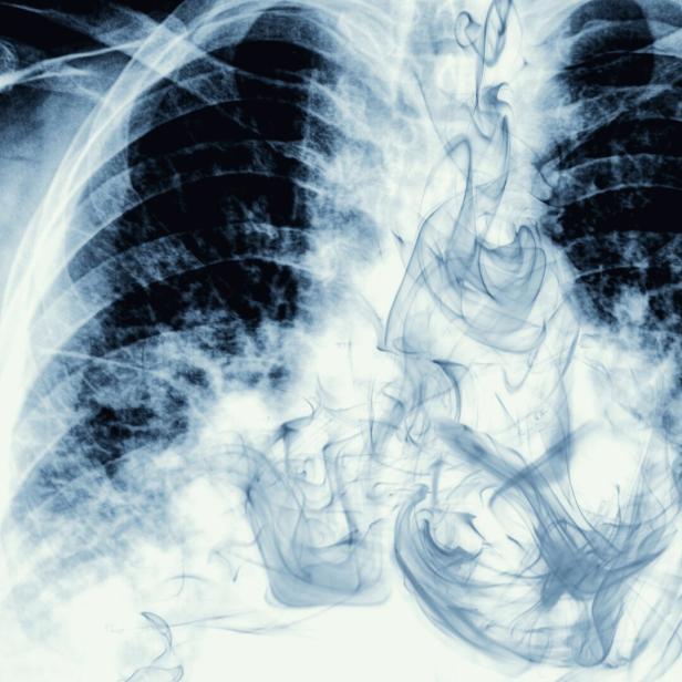 Smoke visible on chest X-ray image