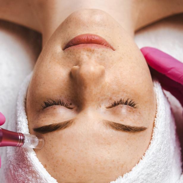 Eine Frau erhält eine Microneedling-Behandlung im Gesicht.