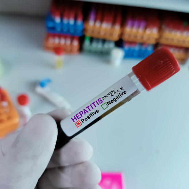 Hepatitis-Virus-Test in Händen eines Labormitarbeiters.