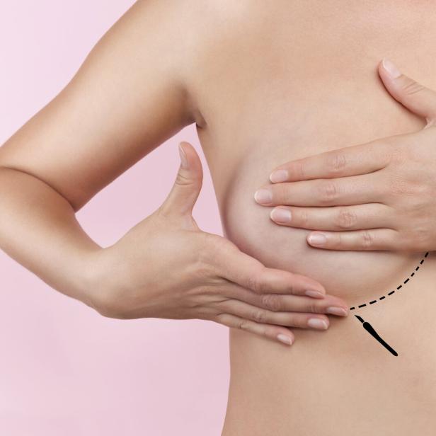 breast augmentation