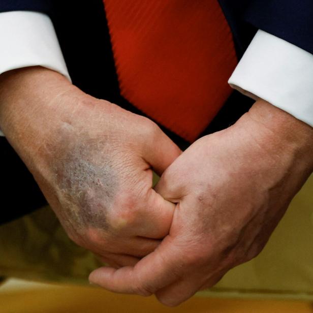 Das Bild zeigt die Hände des US-Präsidenten Donald Trump. Auf dem rechten Handrücken ist deutlich ein Bluterguss zu sehen. 