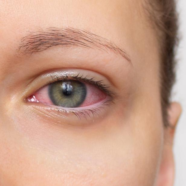 Close Up von einer Frau mit einem roten Auge