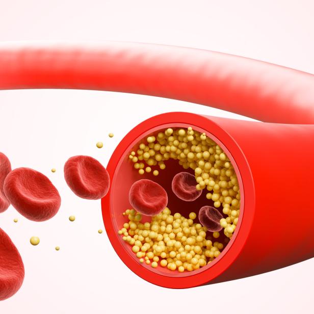 Grafik von Blutzelle und vergrößertes Blutgefäß mit Cholesterin.