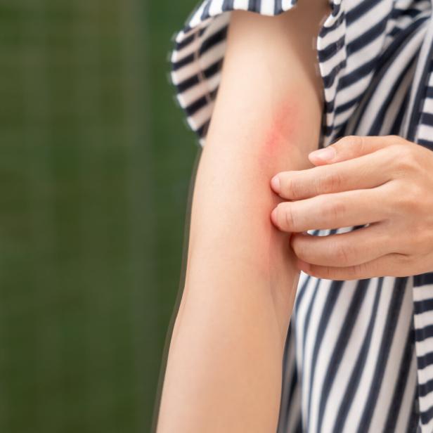 skin problem and beauty. Young woman scratch body has itchy skin from skin allergic, steroid allergy, sensitive skin, red from sunburn, chemical allergy, rash, insect bites, Seborrheic Dermatitis.