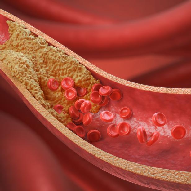 Das Bild zeigt eine grafische Darstellung einer Arterie, die durch Plaques fast verschlossen ist.