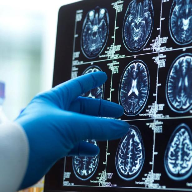 Brain scan image with a doctor's hand, representing medical diagnosis and research.