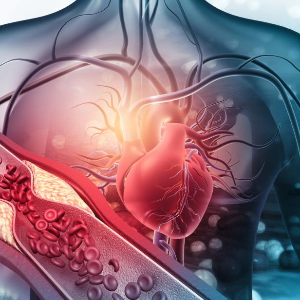 Die Illustration zeigt eine Darstellung des menschlichen Herzens, davor als Symbol ein vergrößertes Blutgefäß, das bereits durch Cholesterinablagerungen verengt ist. 