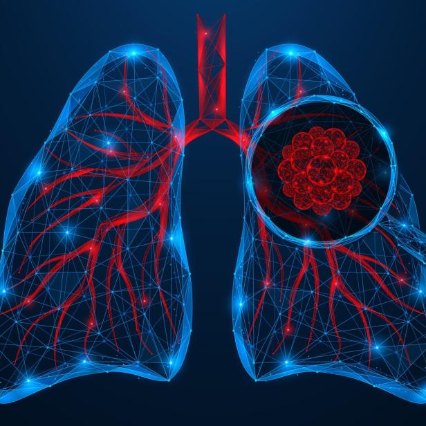 Human lung cancer under a magnifying glass.