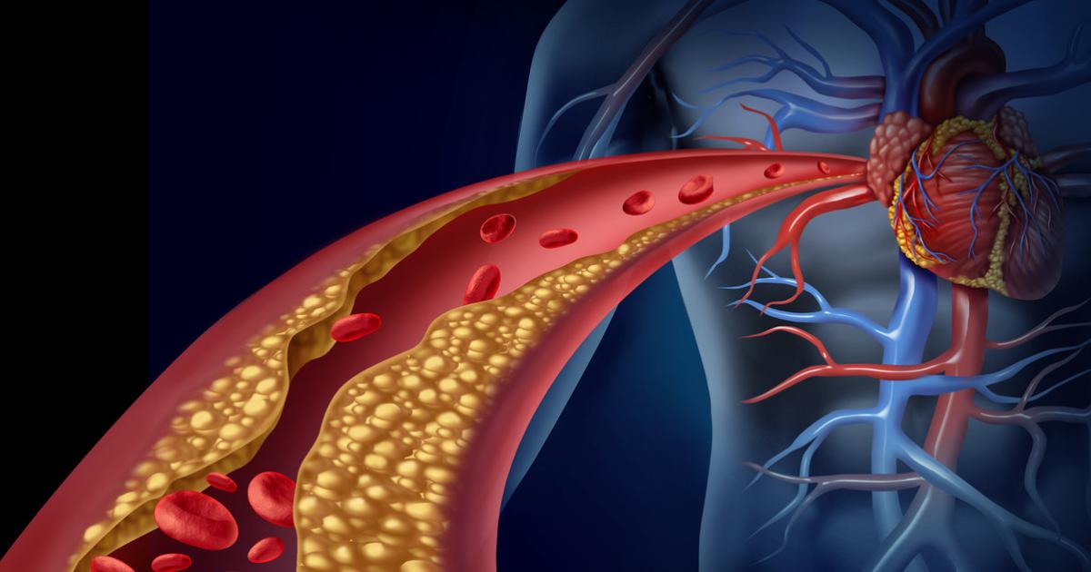 Gefäßverkalkung auch von außen | kurier.at