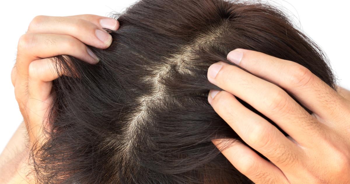 Haarausfall partnersuche