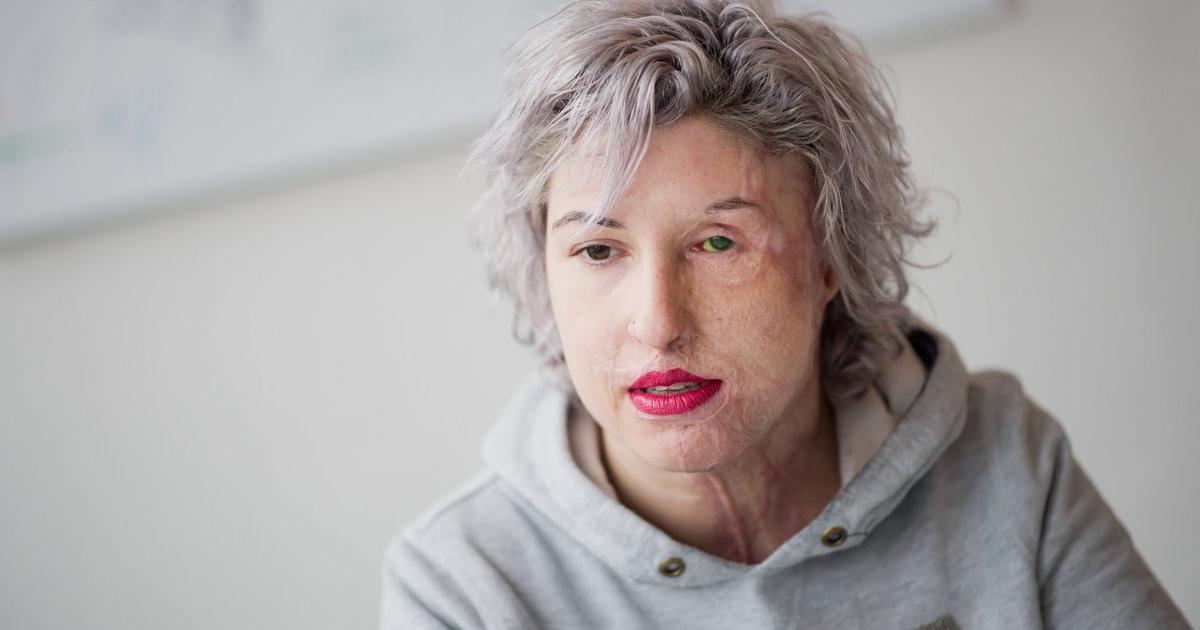 Briefe vom Täter: Säureopfer Vanessa kämpft weiter | kurier.at Zwölfjährige bekam Baby vom Stiefvater | kurier.at
