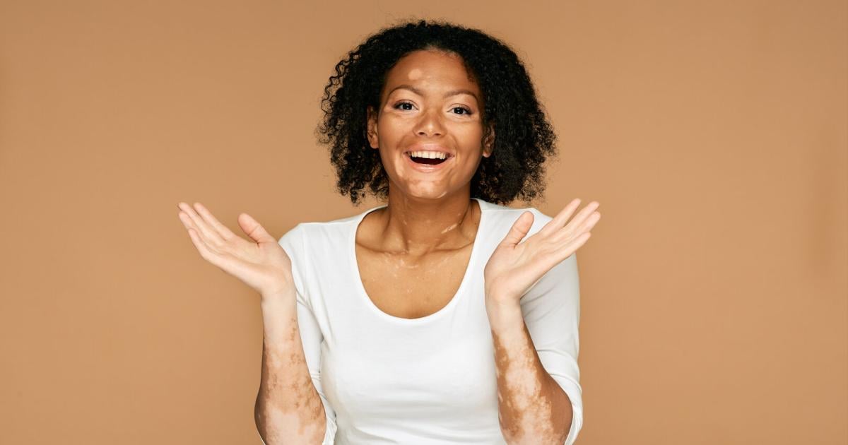 Neue-Selbsthilfegruppe-f-r-Vitiligo-in-Wien