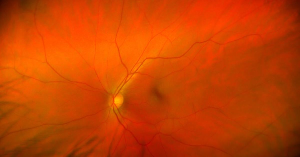 Netzhautverkalkung-Neue-Therapie-mit-Tropfen-in-Sicht-
