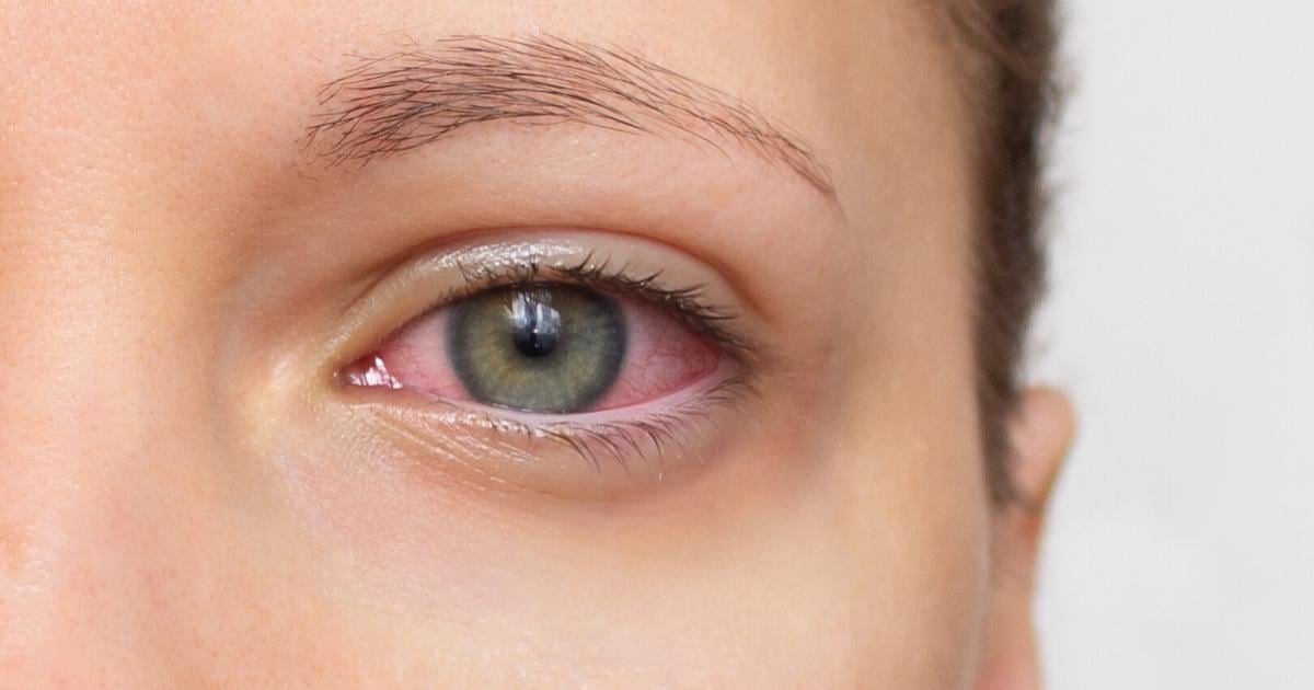 Clusterkopfschmerz-So-schmerzhaft-wie-ein-Messer-im-Auge-