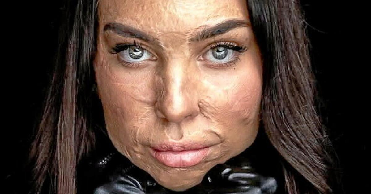 Brand-Katastrophe-in-Crans-Montana-Verletzte-durchleben-die-H-lle-