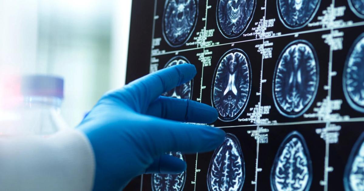 KI-diagnostiziert-Hirntumore-in-Minuten-statt-Wochen
